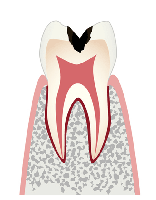 歯の内部（象牙質）まで進行した虫歯