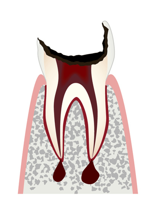歯根まで進行した虫歯