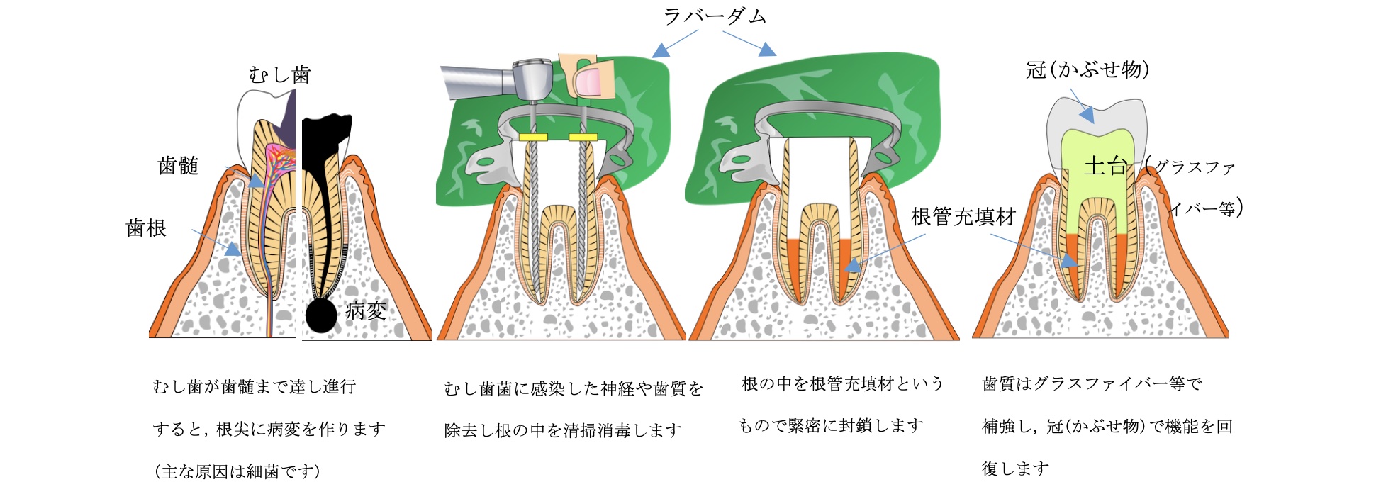 根管治療の経過観察について|岡山市北区北長瀬の歯医者|金山デンタルクリニック