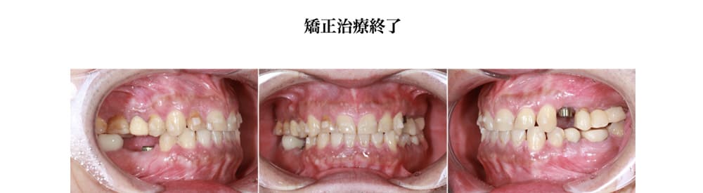 症例1 治療中