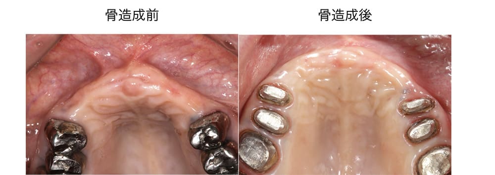 症例2 治療中1