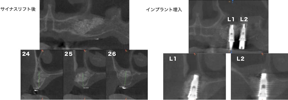 症例3 治療中