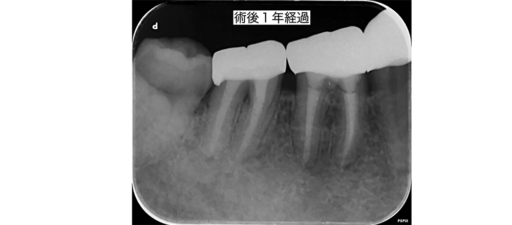 症例4 治療後