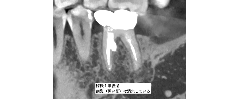 症例5 治療後