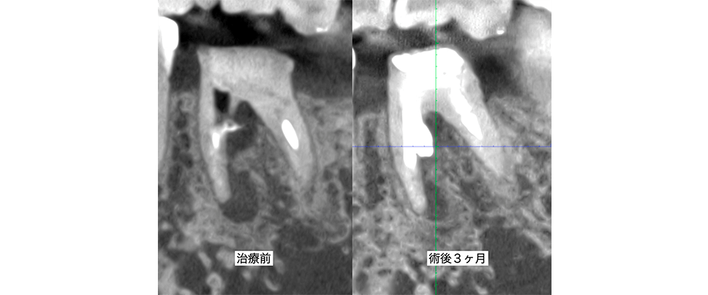 症例5 治療比較